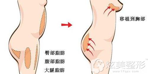 自体脂肪丰胸手术步骤示意图 自体脂肪丰胸手术步骤示意图