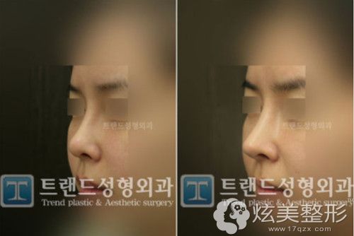 以鼻整形为主打项目的韩国trend做隆鼻失败修复案例超赞整形案例 韩国trend整形医院