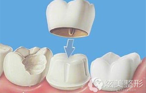 美容冠改善牙齿不齐的手术原理图