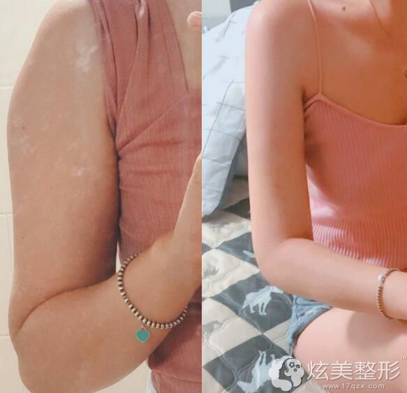 赴韩手臂吸脂对比三家选定365mc切口特写只有一个针眼