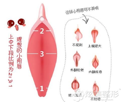 羞羞话题 私密部位肥大的蝴蝶唇想做小阴唇整形手术 小阴唇整形 炫美网