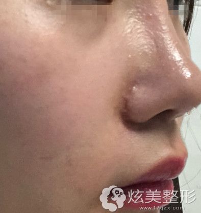 看过鼻翼外切疤痕增生图太吓人就选了内切鼻翼结果