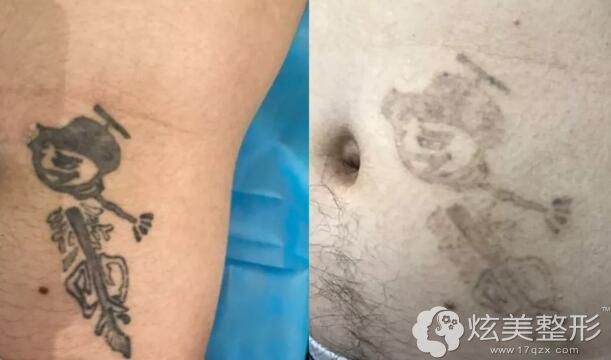 洗纹身洗5次<span alt=