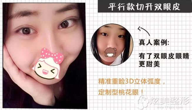 网红款自然风平行眼你想要的双眼皮风格都有对比照