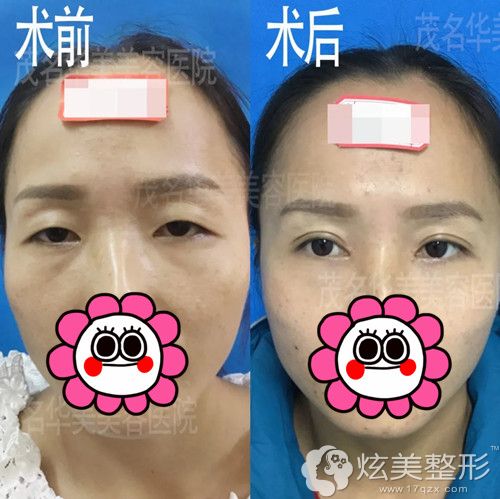 光做双眼皮还是丑可能你还需要做上睑肌矫正眼窝填充