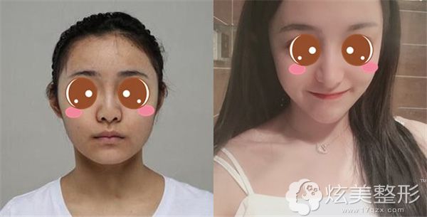 【没有劈外板的案例】:术后自述:因为左右两边脸型不对称的原因,在