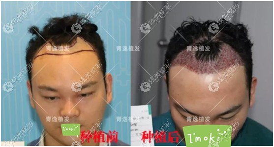 担心m型发际线成秃顶 赶紧到广州青逸做了1000单位毛发移植