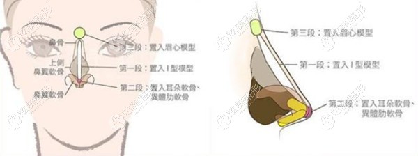 刘天一医生做隆鼻手术