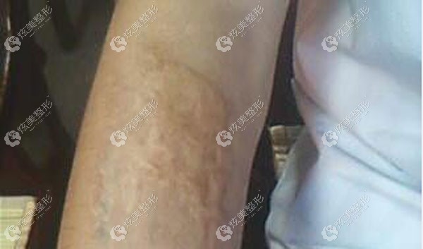 去了趟上海虹桥医院疤痕科，看完案例后感觉胳膊上烧伤的疤有救了
