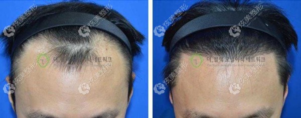 放一波韩国布莱克毛发移植中心做男女发际线移植的术后对比图