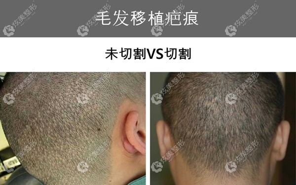 这里有一波韩国布莱克毛发移植中心做男,女发际线移植的效果图哦