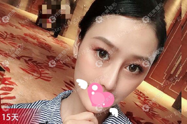 去长沙艺星做半肋鼻综合手术效果图分享半个月左右就恢复了
