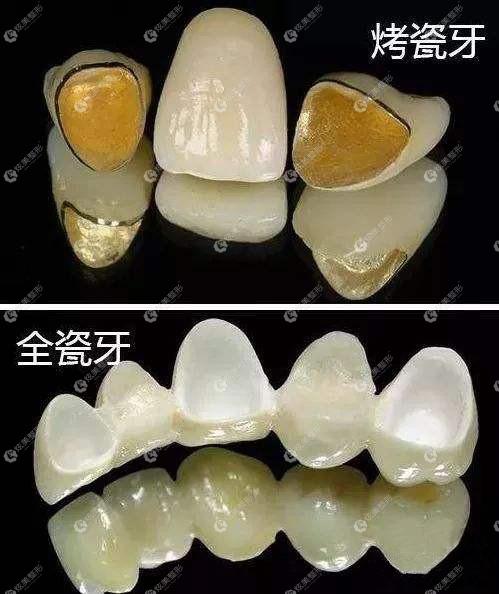 钛合金牙冠对人体有没有损伤