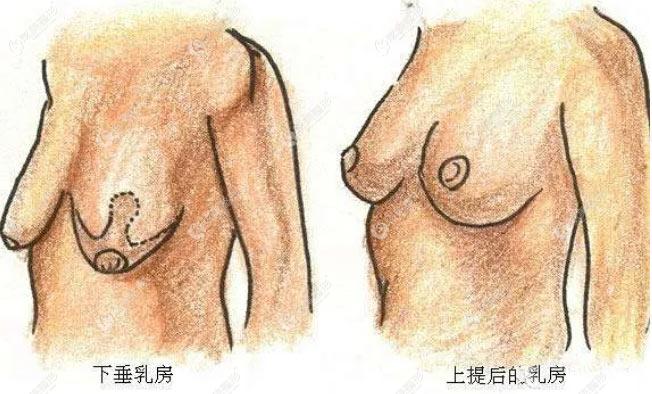 乳房下垂矫正恢复图对比照