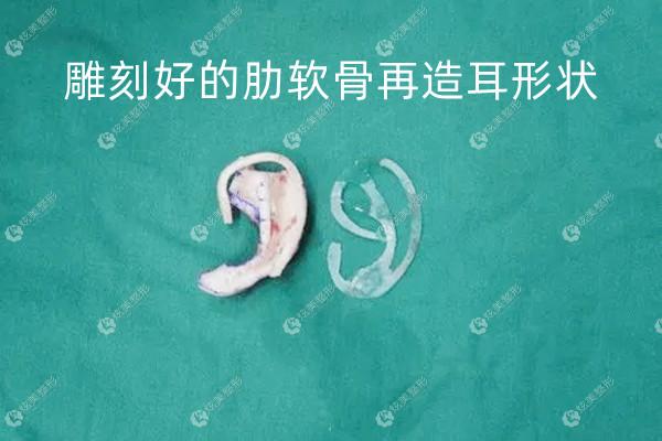 耳再造手术可以报销吗_耳再造国内最顶级专家_再造真耳