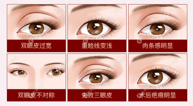 白永辉医生修复双眼皮的种类多