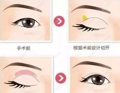 全切双眼皮改善上眼皮松弛过程