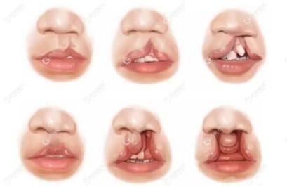 郭树忠医生针对图中的唇腭裂情况都能进行修复
