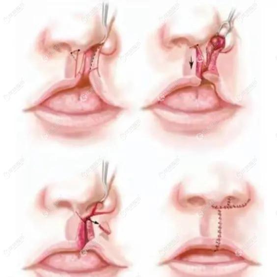 师俊莉医生做唇腭裂修复手术的简易原理图