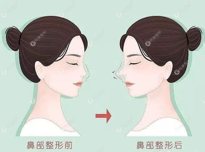 杭州时光哪位医生做鼻子好？胡斌、项昌峰做隆鼻技术蛮好的