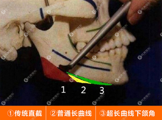 杭州连天美做下颌角手术方式不同费用有差异