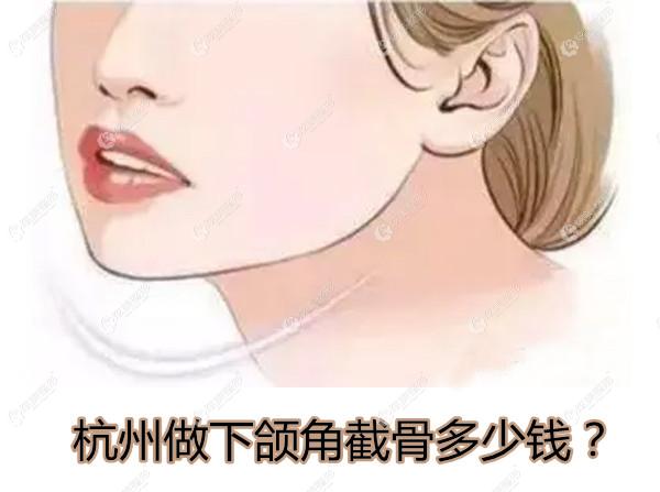 杭州做下颌角截骨多少钱？可参考杭州连天美、时光切除下颌角手术的价格