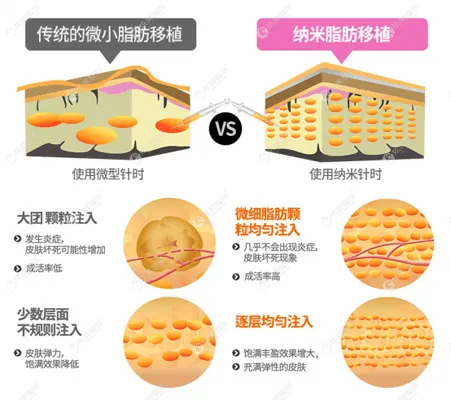 杭州做纳米脂肪填充和普通脂肪填充的价格不同