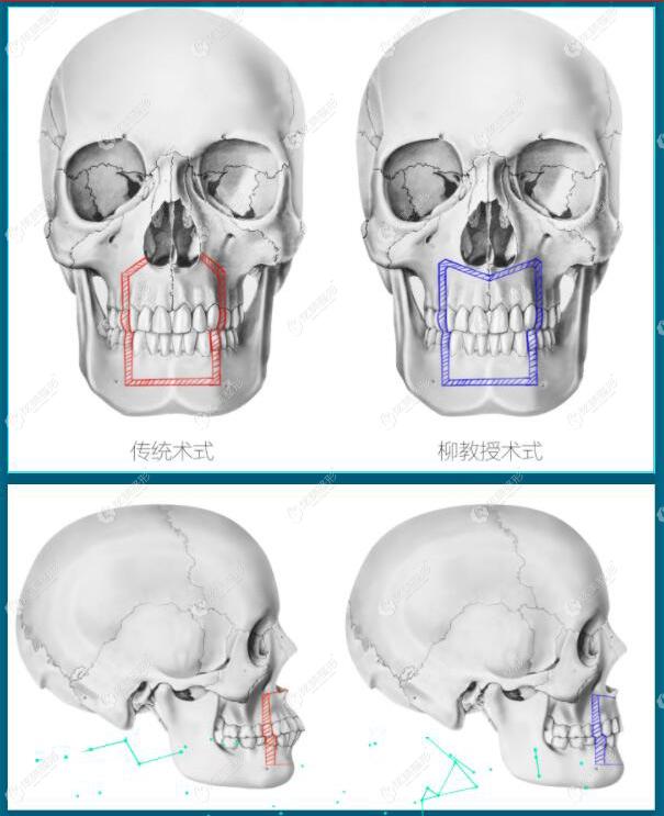 柳春明和王瑞晨做颌骨M形截骨术矫正双颌前突技术