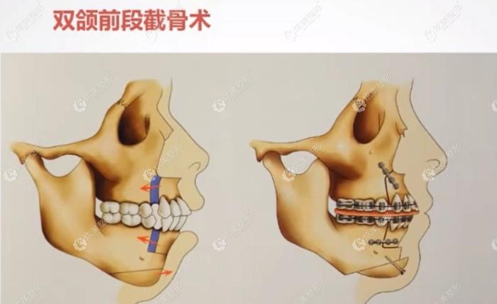 重庆正颌手术费用多少?重庆松山等医院给出凸嘴正颌价格6万起整形案例 - 重庆松山医院 - 炫美网